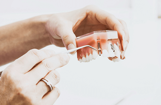 Implantes Dentários